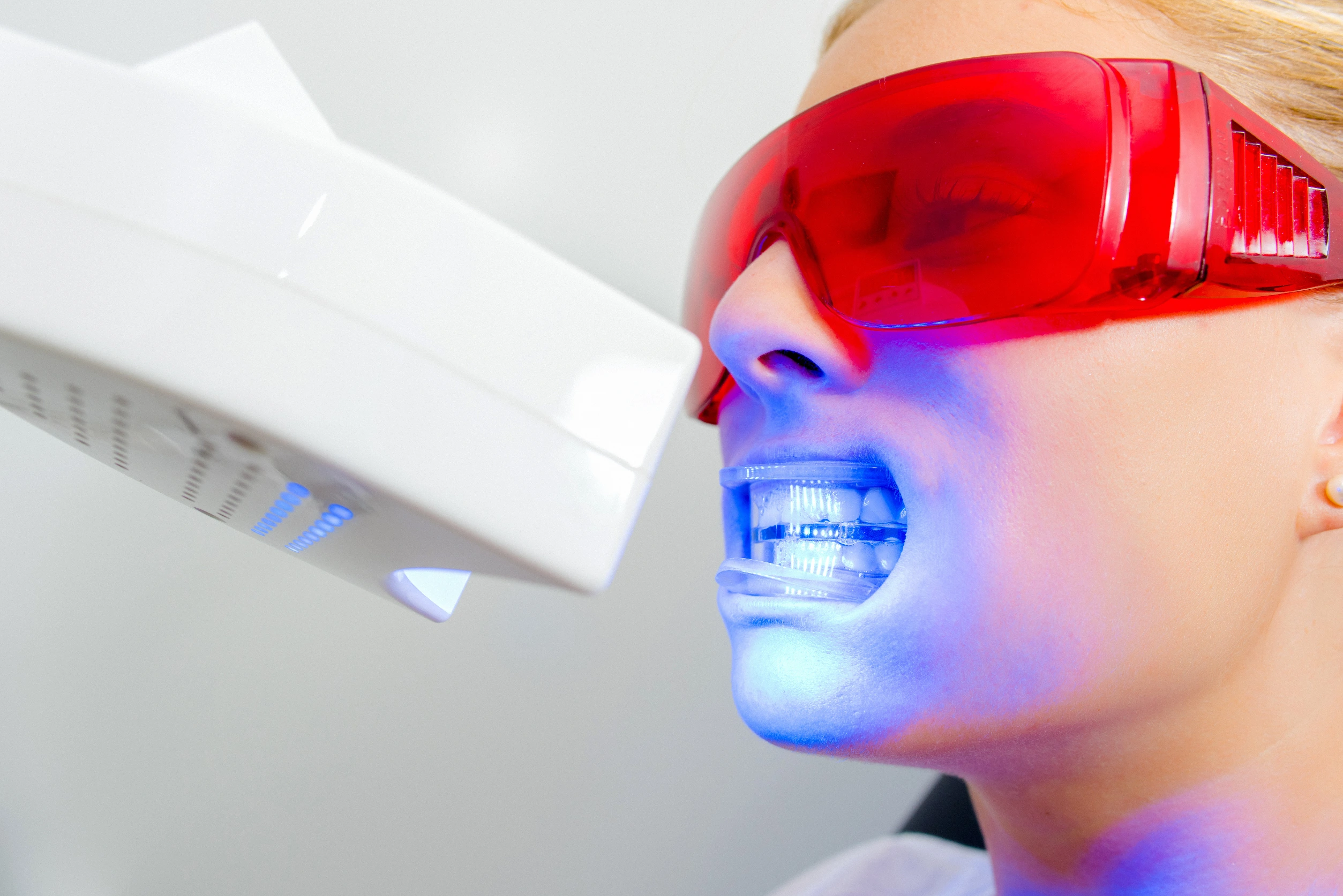 Teeth Whitening